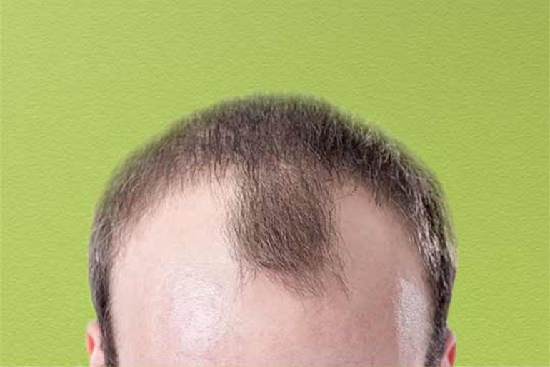 Für eine Haartransplantation besser zum Arzt - Artikel - saldo.ch